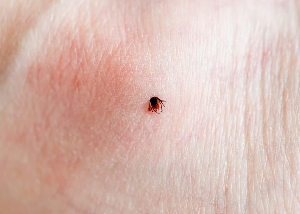 A tick embedded in a person skin.